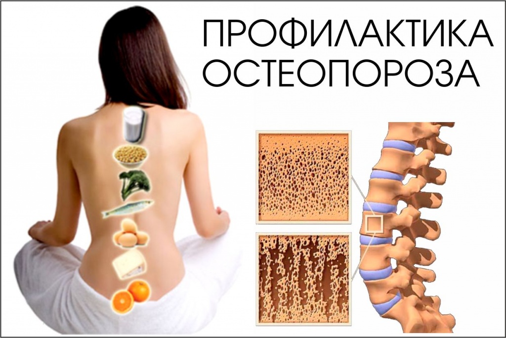 Остеопороз. Факторы риска развития остеопороза.
