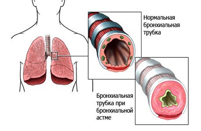 что такое астма.png