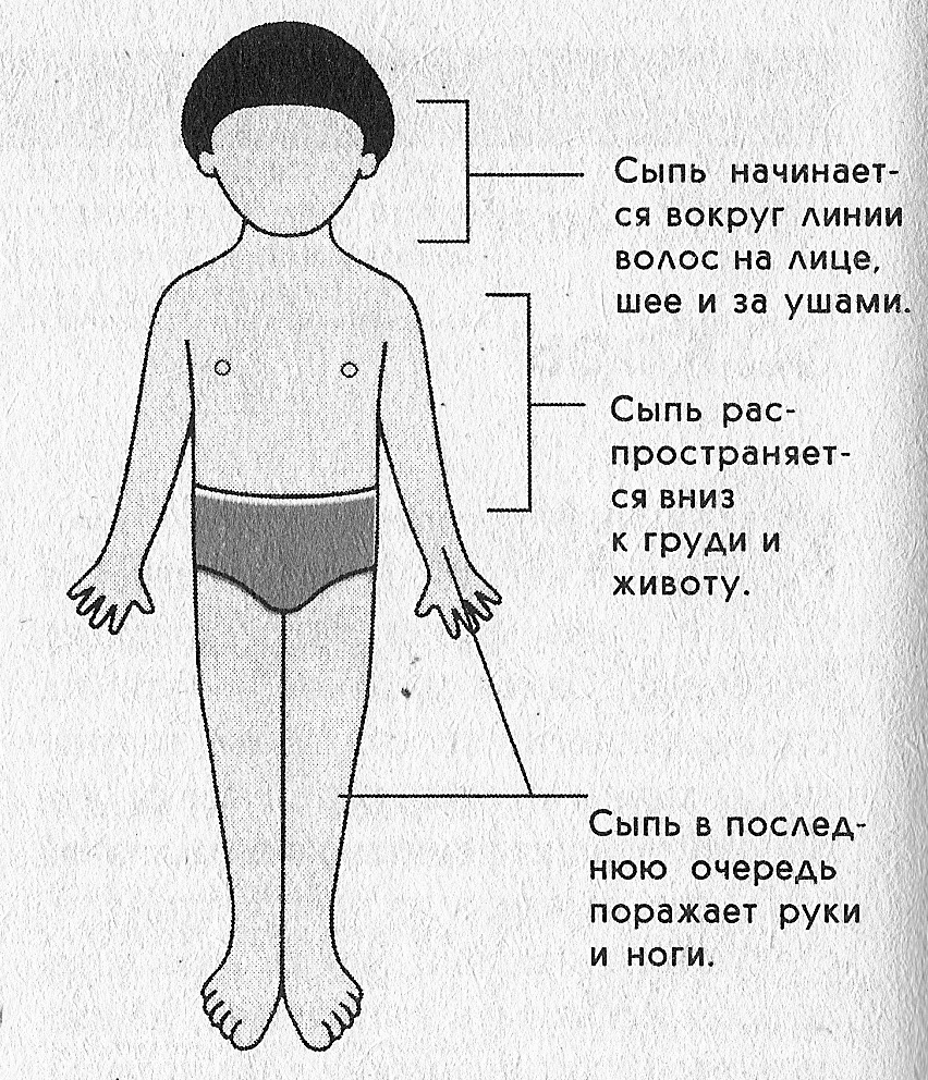 Рисунок сыпь корь